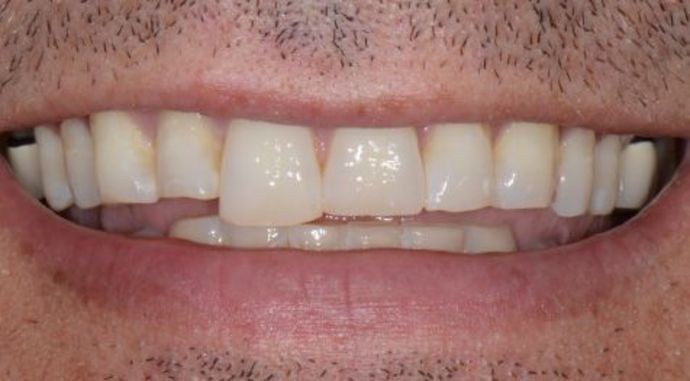 Bonding Case 1 - Before