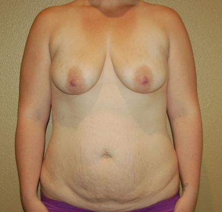 Mommy Makeover Case 63 - Before