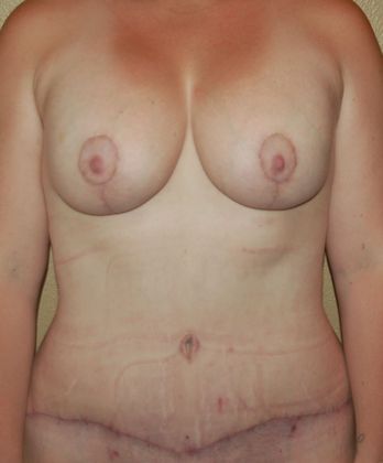 Mommy Makeover Case 63 - After