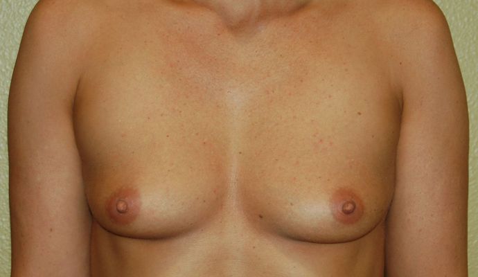 Breast Augmentation Case 322 - Before