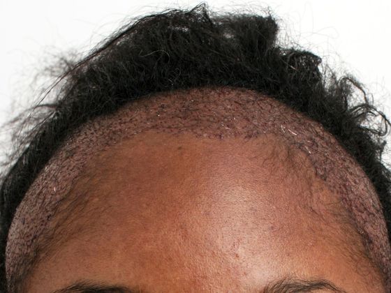 Hair Transplant - Female: Traction Alopecia FUT (3) - Before/Post-op