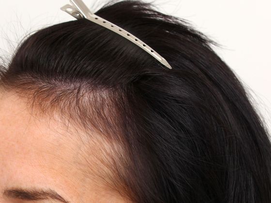 Hair Transplant - Female: Hairline FUT (7) - Before female hair transplant