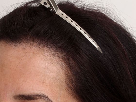 Hair Transplant - Female: Hairline FUT (7) - After female hair transplant