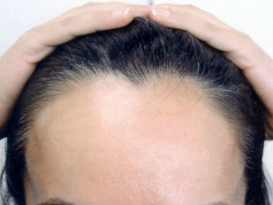 Hair Transplant - Female Hairline FUT (5) - Before