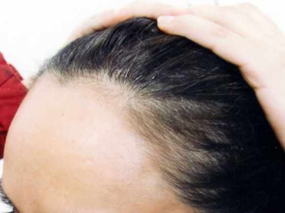 Hair Transplant - Female: Hairline FUT (5) - Before female hair transplant