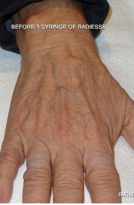 Hand Rejuvenation Case 1 - Before