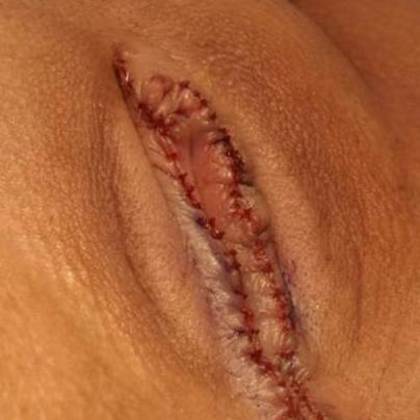 Labiaplasty Case 3 - Labiaplasty Norwalk - After