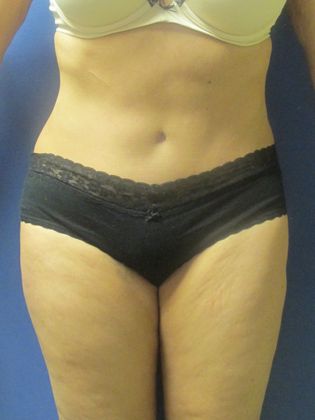 Liposuction: Case 8 - After