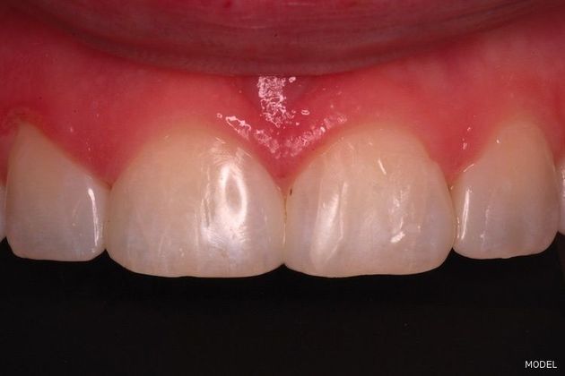 Composite Bonding Case