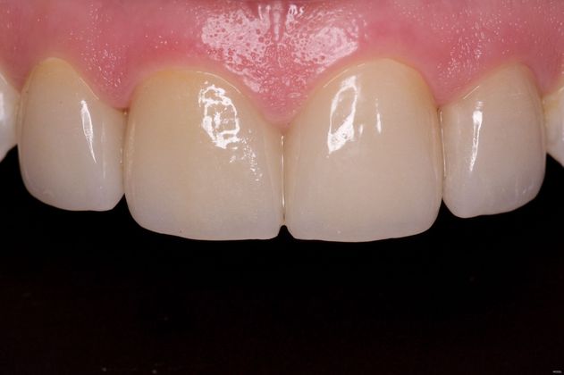 Porcelain Crowns Cases