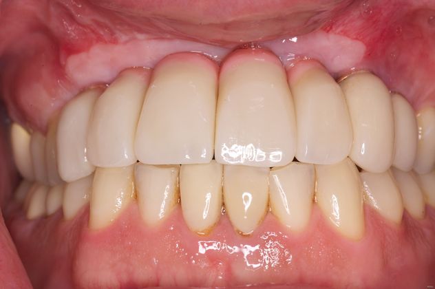 Full Mouth Reconstruction Cases