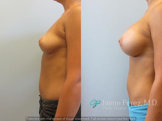 Breast Augmentation: Saline Breast Augmentation - 425cc