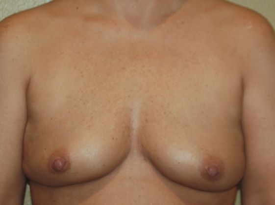 Breast Augmentation Case 324 - Before