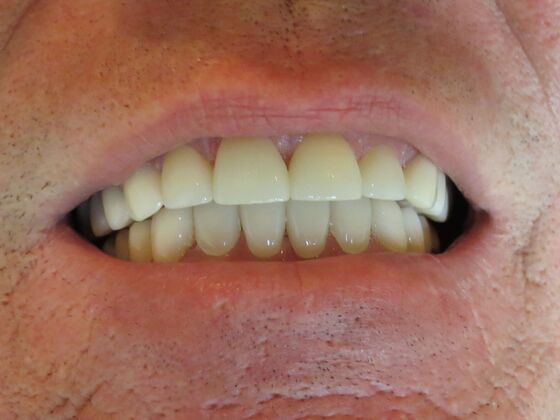 Full Mouth Rehabilitation, actual cases of our dentists, no special lighting or editing: Case 1 - After full mouth rehab