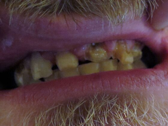 Full Mouth Rehabilitation, actual cases of our dentists, no special lighting or editing Case 2 - Before