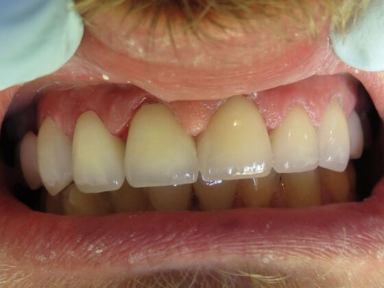 Full Mouth Rehabilitation, actual cases of our dentists, no special lighting or editing Case 2 - After