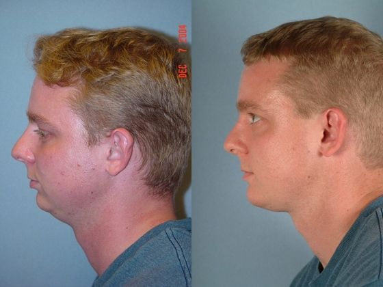 jawline surgery men before and after