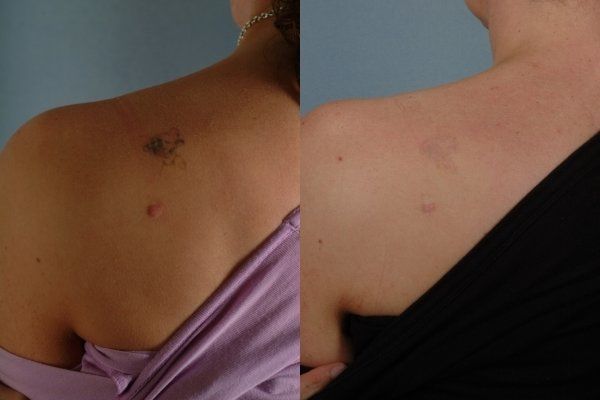 Laser Tattoo Removal  Little Rock AR  Dr Suzanne Yee