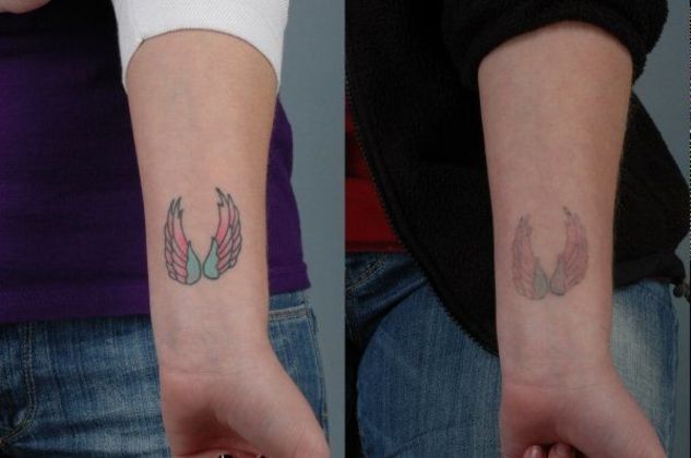 Conway - Laser Tatoo Removal - Before and After Gallery