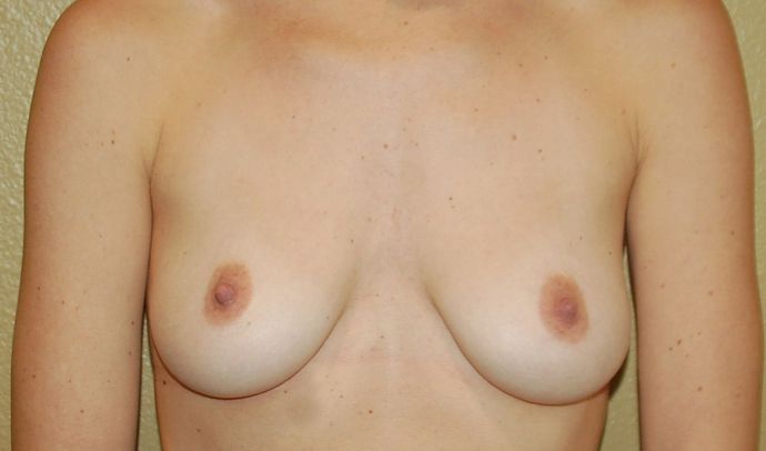 Breast Augmentation w/ Lift Case 144 - Before