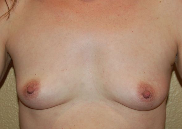 Breast Augmentation Case 329 - Before