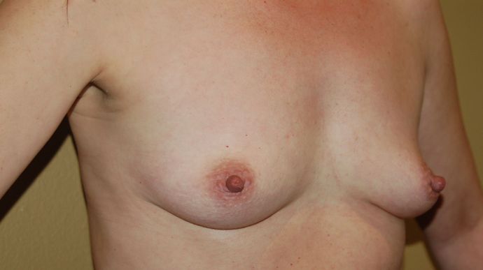 Breast Augmentation Case 329 - After