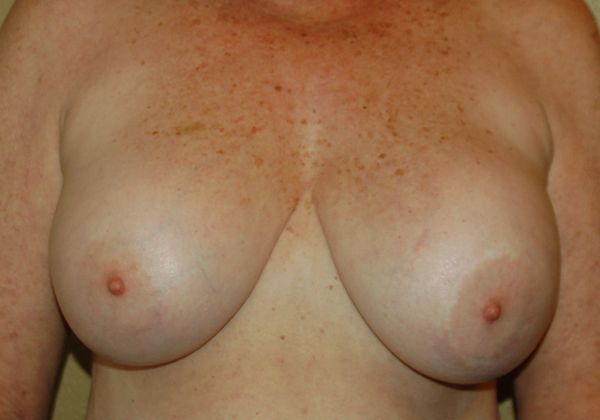 Breast Revision: Case 50 - Before