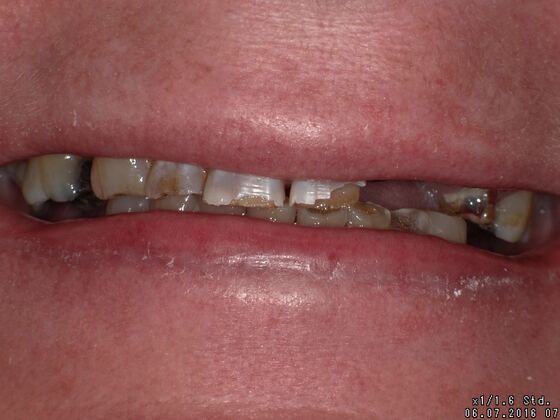 Smile Design Case 3 - Before