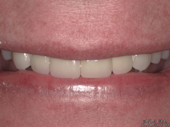 Smile Design Case 3 - After