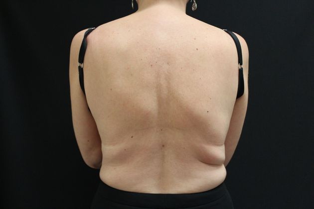 Liposuction Case 5 - Before