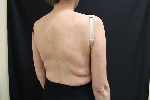 Liposuction: Case 5 - Before