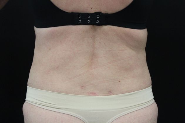 Liposuction Case 5 - After