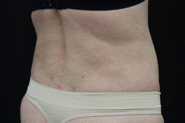 Liposuction: Case 5 - After