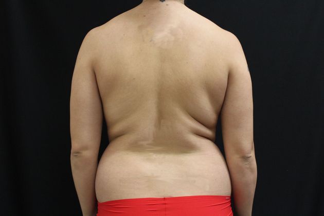 Liposuction: Case 6 - Before