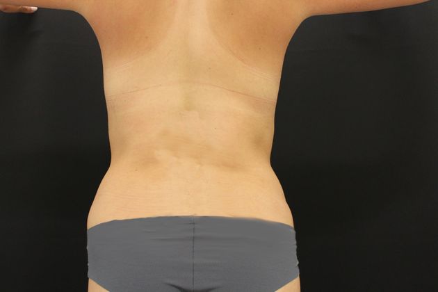 Liposuction: Case 6 - After