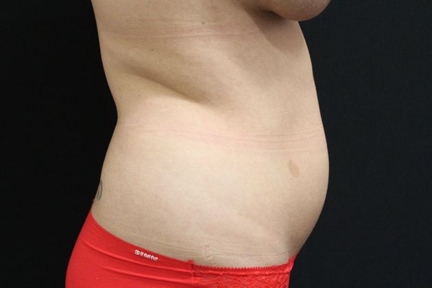 Liposuction: Case 6 - Before