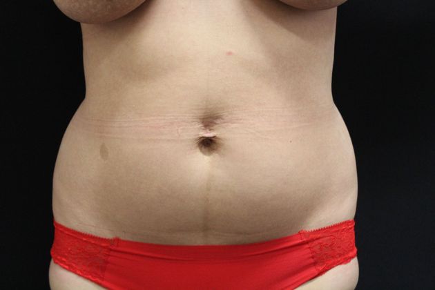 Liposuction: Case 7 - Before