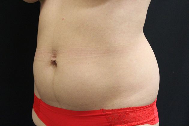 Liposuction: Case 7 - Before