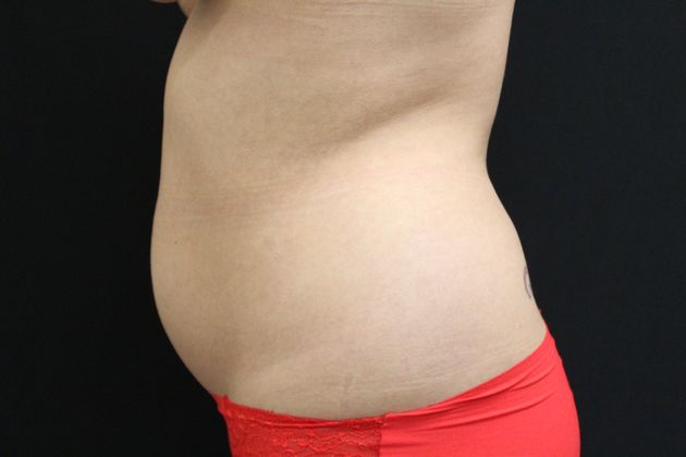 Liposuction: Case 7 - Before