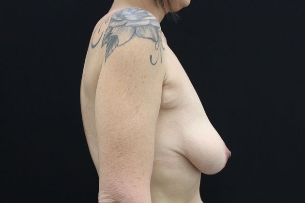 Breast Lift/Breast Lift Augmentation: Case 17 - Before
