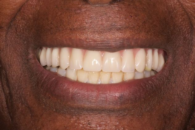 Dental Implant Supported Dentures Case