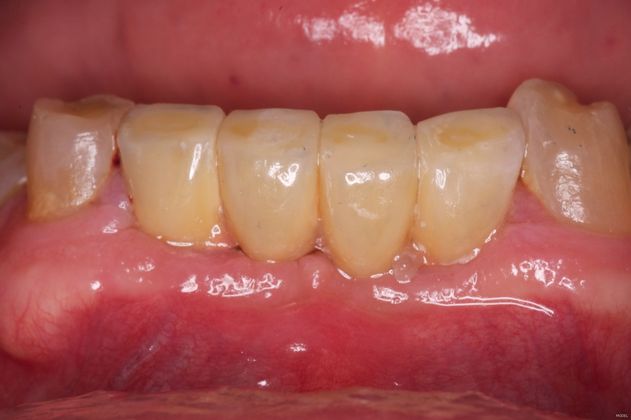 Dental Implant Fixed Bridge Cases