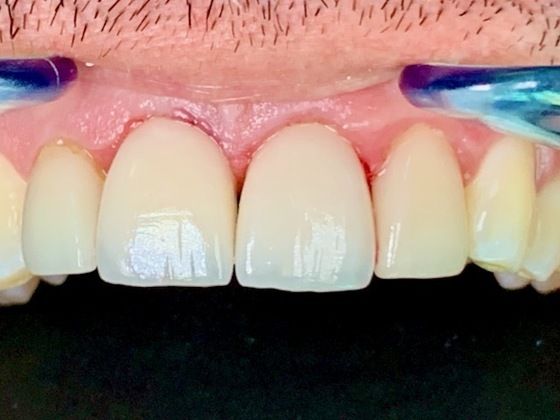 Dental Implants Cases