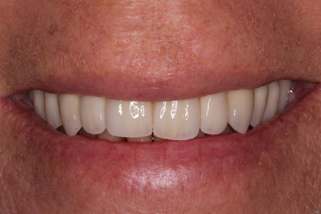 Full Arch Reconstruction with Individual Dental Implant Teeth Cases