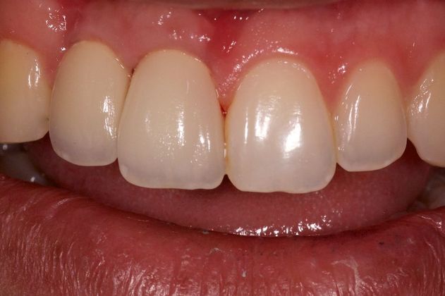 Dental Implants for Multiple Front Teeth: Case 1 - AFTER Dental Implant for Fractured Front Teeth