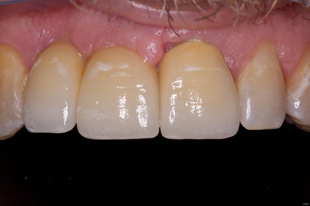 Dental Implants to Replace Broken Fixed Bridges Case