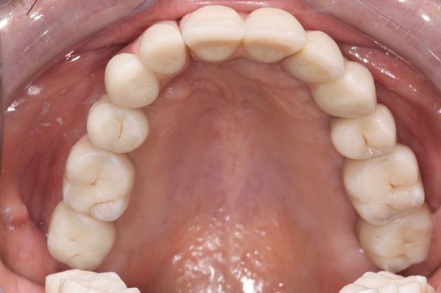 Full Arch Reconstruction with Individual Dental Implant Teeth Case 2