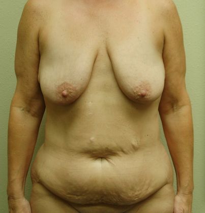 Mommy Makeover Case 64 - Before