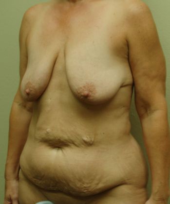 Mommy Makeover: Case 64 - Before