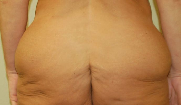 Buttock Lift Case 4 - Before